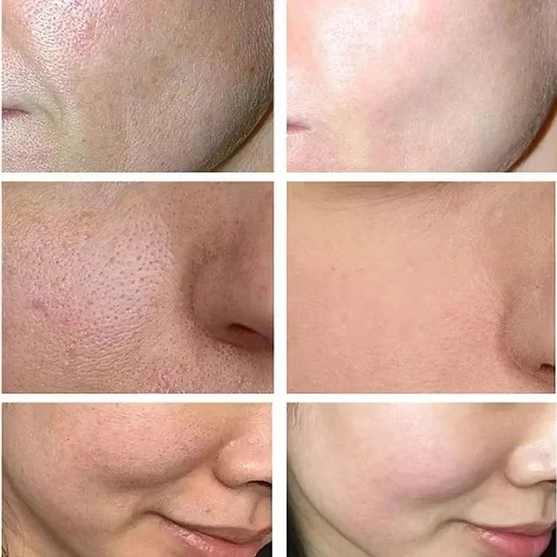 Crema restringente dei pori al - Azelaic Acid Cream recensione e prezzo