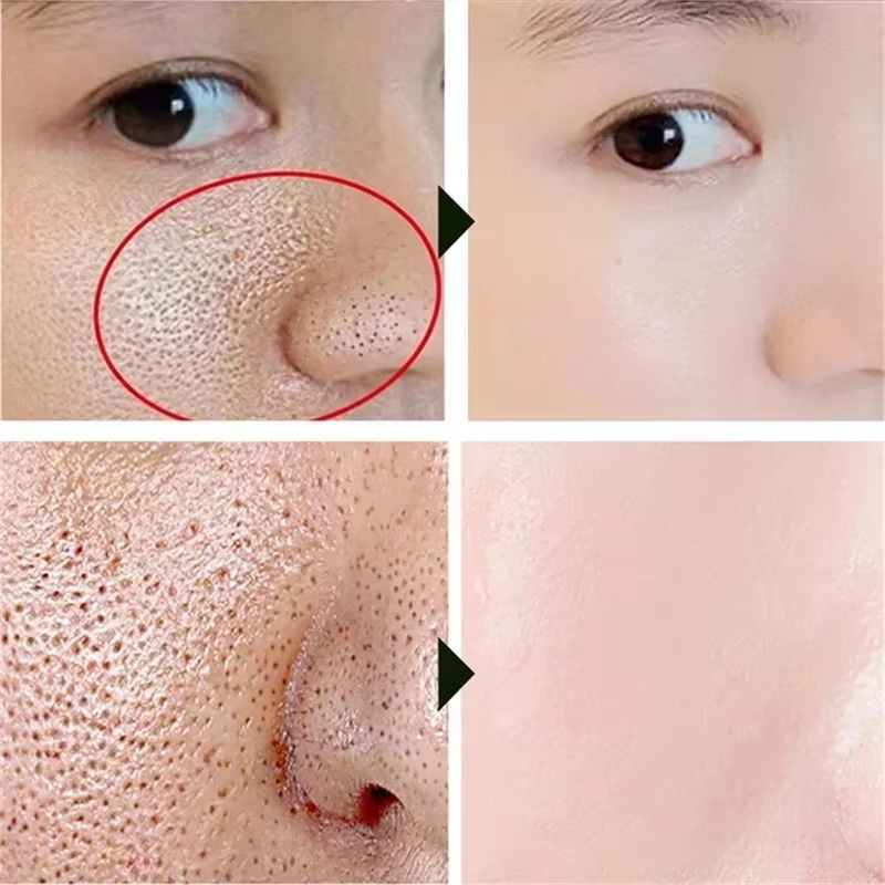 Crema restringente dei pori al - Azelaic Acid Cream recensione e prezzo